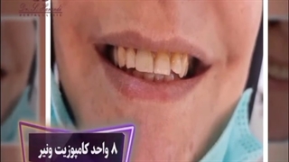 کامپوزیت ونیر فک بالا