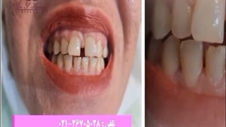 کامپوزیت ونیر و بستن فاصله دندانی(دیاستم)