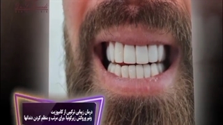 زیبایی ترکیبی از کامپوزیت ونیر وروکش زیرکونیا