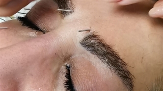 از بین بردن خطوط اخم روی پیشانی