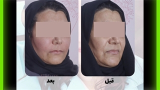 بهترین دکتر و پزشک برای تزریق چربی یه روش نانوفت تزریق بوتاکس