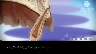 دکتر وحید دهقان : شکستگی دندان