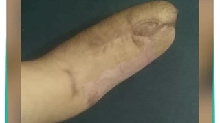 پروتز زیبایی دست-پروتزیست موسوی