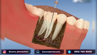 درمان ریشه دندان در مشهد