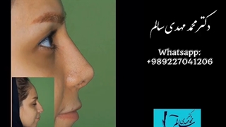 جراحی زیبایی بینی بعد از سه هفته- دکتر محمد مهدی سالم