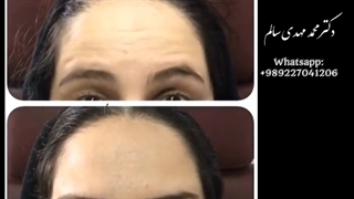 تاثیر بوتاکس بعد از یک هفته- دکتر محمد مهدی سالم