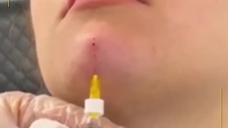 افزایش حجم و مدل سازی چانه آر اف فرکشنال