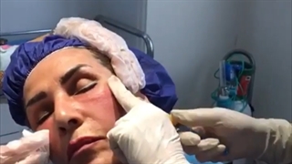 تزریق چربی جهت فرمدهی صورت