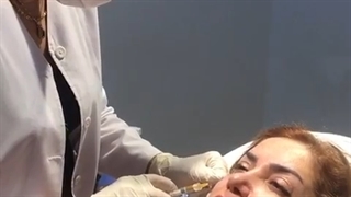 تزریق فیلر زیر چشم