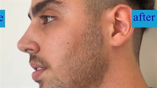 تزریق دو سی سی فیلر چانه