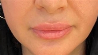 تزریق ژل خط خنده