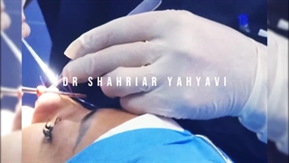 قبل و بعد از جراحی زیبایی بینی