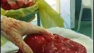 جراحی هیسترکتومی (رحم بزرگ و پر از فیبروم) توسط دکتر واحدپورفرد