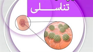 زگیل های تناسلی