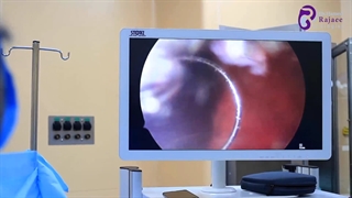 جراحی آندوسکوپیک سنگ حالب