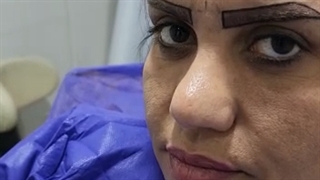 کلینیک کاشت ابرو با لیزر در تهران باکادری مجرب و محیطی آرام