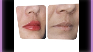 تزریق ژل لب روسی