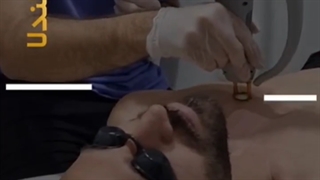 لیزر آقایان