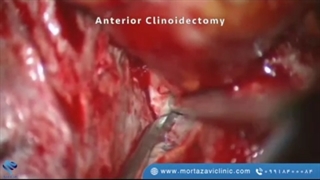 بستن آنوریسم پاره نشده ی نوک شریان بازیلار