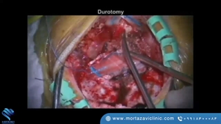 رزکسیون همانژیوم ورمیس فوقانی