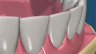 ایمپلنت دندان