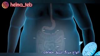 عمل جراحی رباتیک اسلیو معده چیست؟