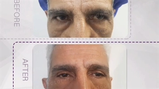 جراحی زیبایی پلک