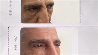 جراحی زیبایی پلک فوقانی و تحتانی