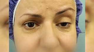 افتادگی پلک