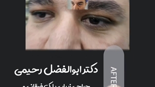 جراحی زیبایی پلک فوقانی