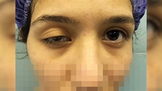 افتادگی پلک