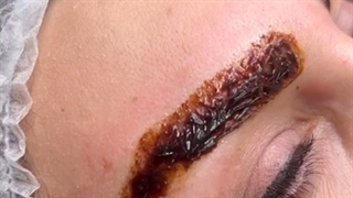 رنگ تاتو رو نابود کرد