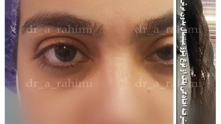 جراحی پیشرفته افتادگی پلک