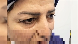جراحی زیبایی پلک