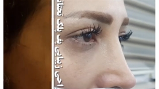 پف پلک تحتانی