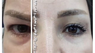 جراحی زیبایی پلک فوقانی