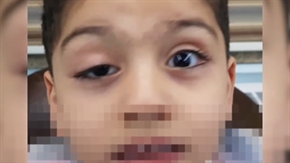 پتوز مینیمال