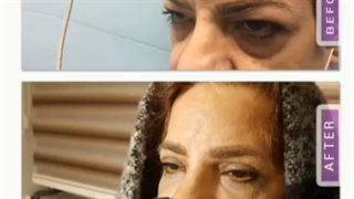 جراحی زیبایی پلک فوقانی