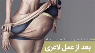 آیا بعد از کاهش وزن، افتادگی پوست خواهم داشت؟