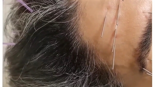 جوانسازی پوست صورت و کلاژن سازی ارتودنسی