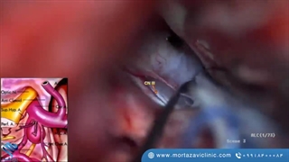 جراحی آنوریسم های مختلف مغزی