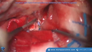 جراحی تومور توبرکلوم سل مننژیوما