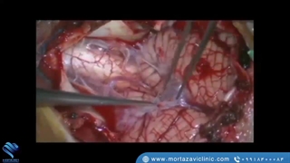 جراحی قسمت خلفی قاعده جمجمه