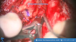 کرانیوتومی سمت چپ