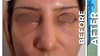 رفع پف پلک بدون برش