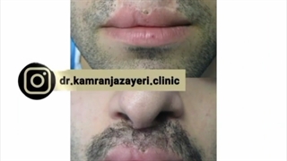 نمونه های کاشت ریش و سبیل