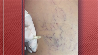 درمان واریس پا