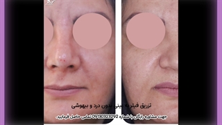 تزریق فیلر دندان پیش