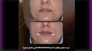 تزریق فیلر برداشتن توده