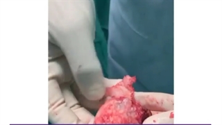 سیاه شدگی شدید سر استخوان ران